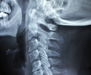 X-ray of the upper spinal column